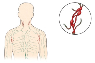 림프종 증상 원인 치료