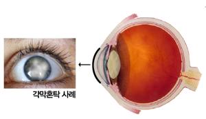 각막혼탁