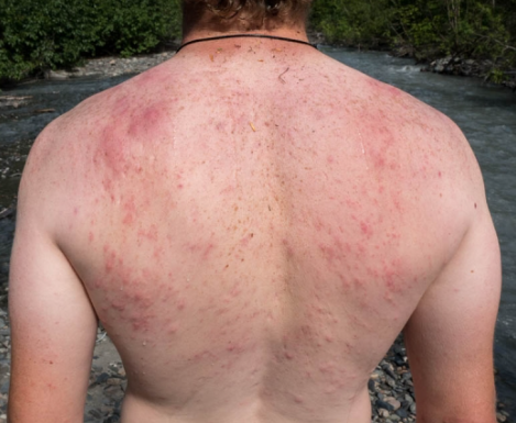 등산 갔다가 풀독 올랐을 때 쎄레스톤지 크림이 직빵!