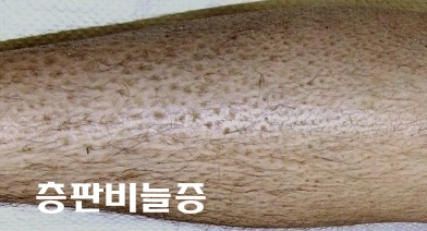 층판비늘증