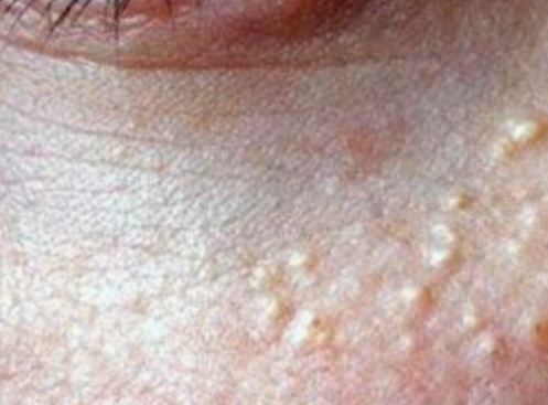 비립종 한관종 치료비용·방법 비교