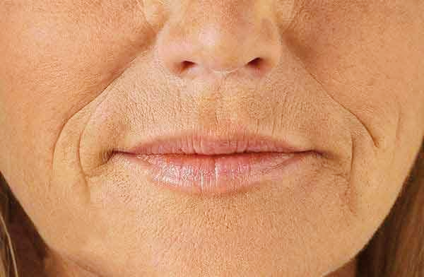 팔자주름 두가닥 모양