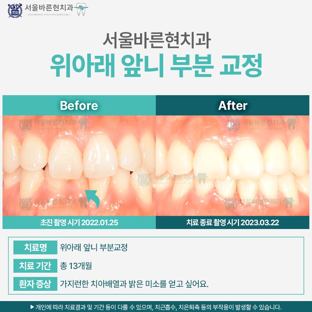 해운대치아교정