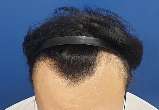 앞머리-헤어라인