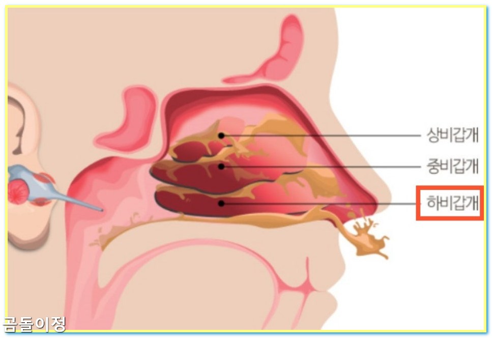 만성비염 극복 후기 광선치료로 코막힘 사라진 리얼 체험담