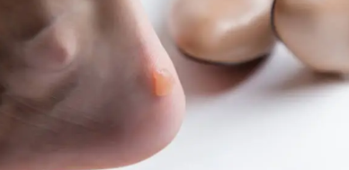 겨울철 난방기구 화상