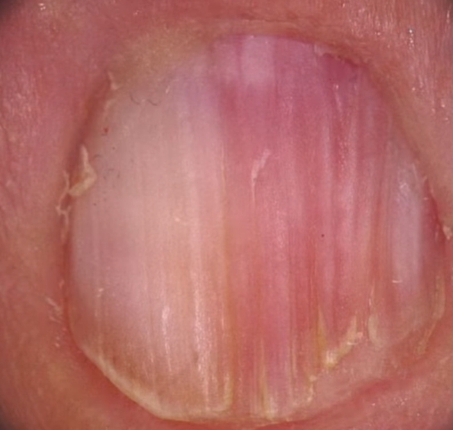 손톱이 잘 부러지는 이유