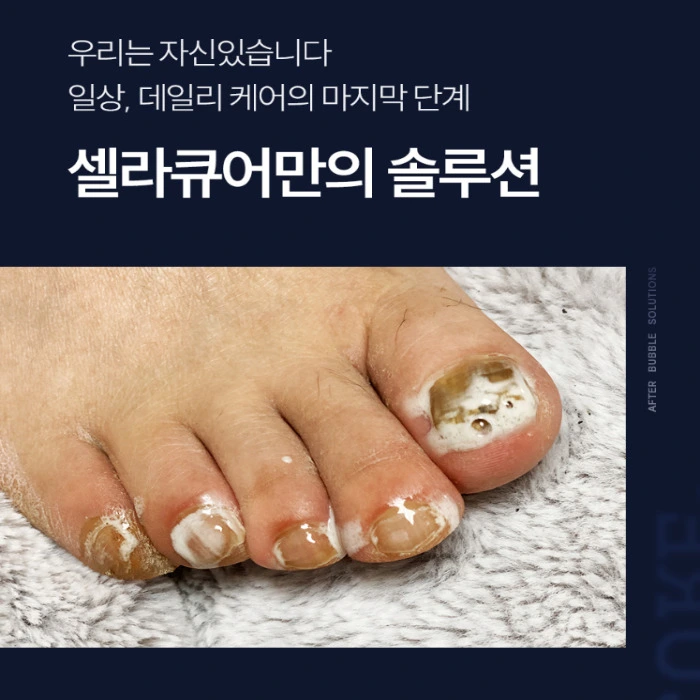 셀라큐어 문제성 발톱 솔루션 내돈내산 후기 부작용 성분 효능 사용법 가격