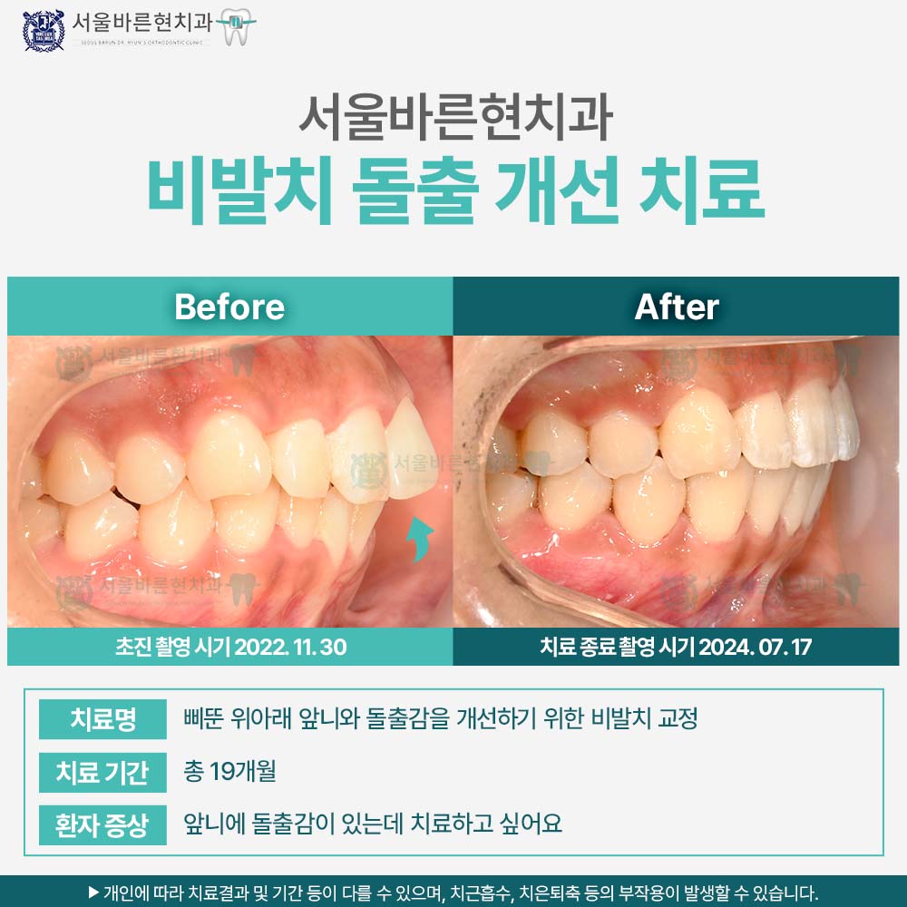 부산치아교정