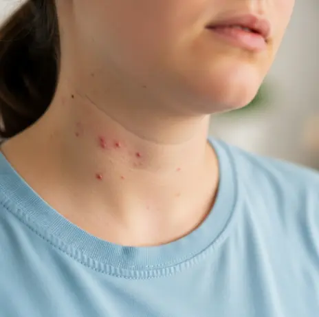 목에 알레르기성 두드러기