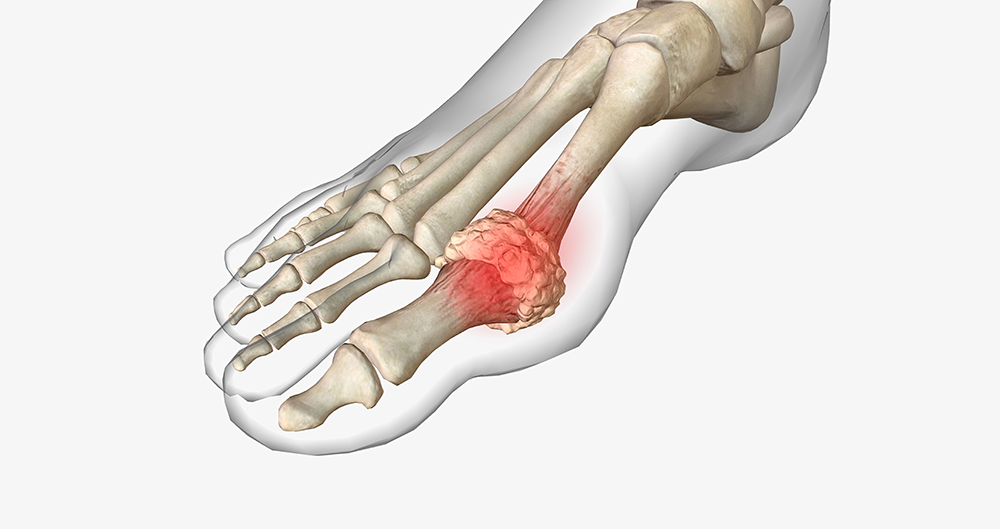 통풍에 해로운 음식