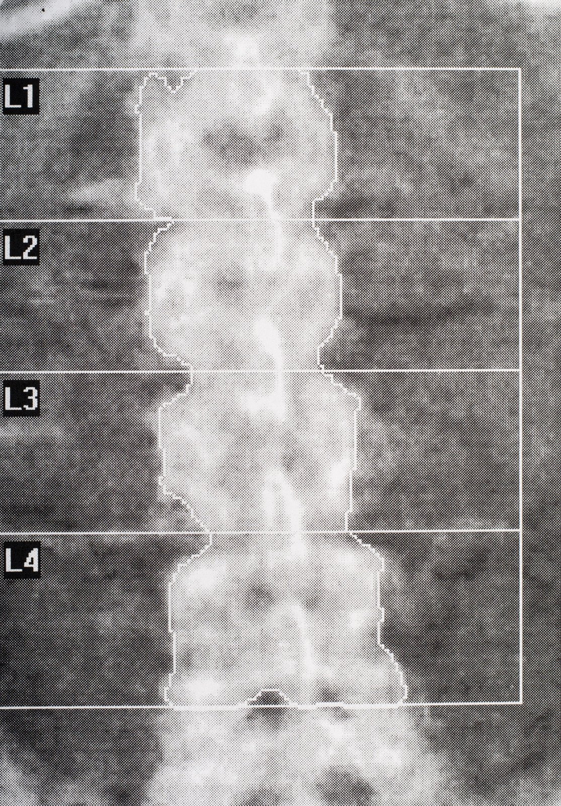 골감소증 (Osteopenia): 골다공증 전 단계