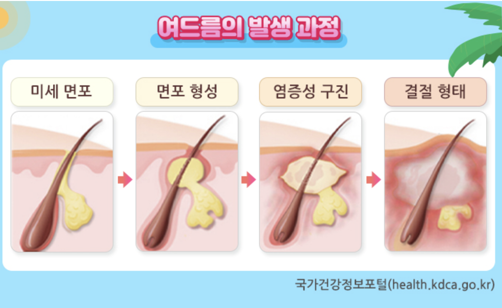 여드름 발생과정