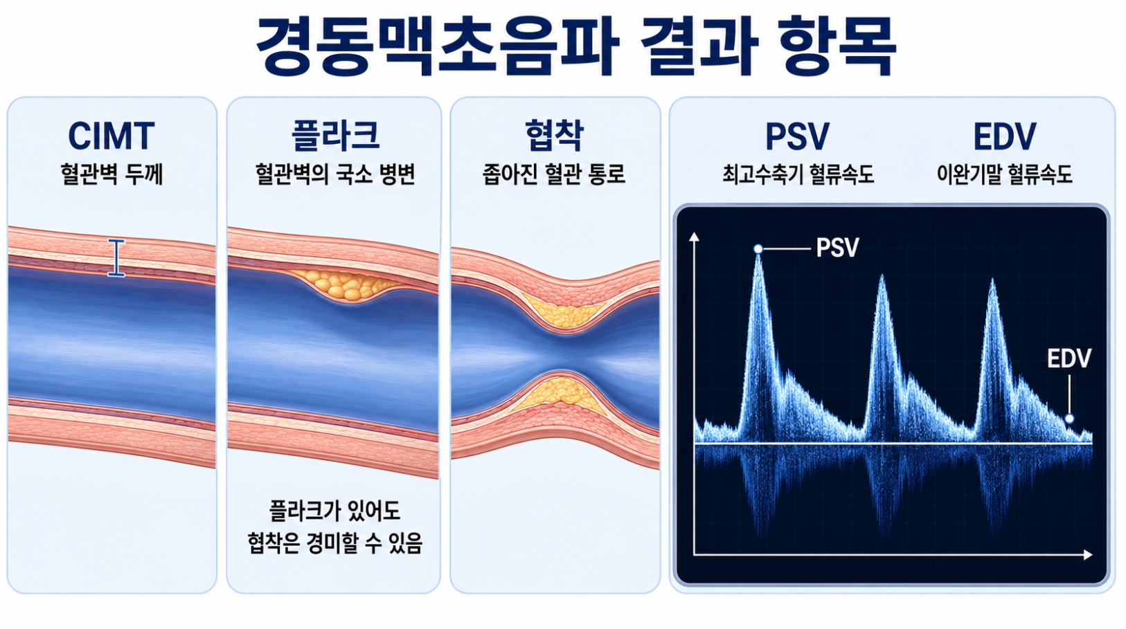 경동맥초음파 결과 항목인 CIMT 플라크 협착 PSV와 EDV 설명