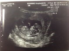 초음파-검사에서-아이의-형태가-명확한-모습