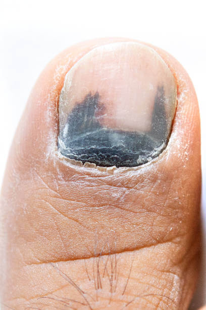 손톱 세로줄과 가로줄 원인이 당뇨와 암일까요? 손톱에 색깔이 변하거나 이상이 생기면 암을 생각할 수 있는데요~ 그 증상들과 관련이 있는지 참고하시기 바랍니다.