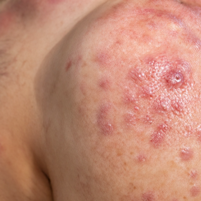 땀띠 가라앉히기 위한 방법