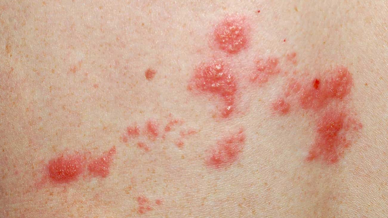 대상포진의 전염성