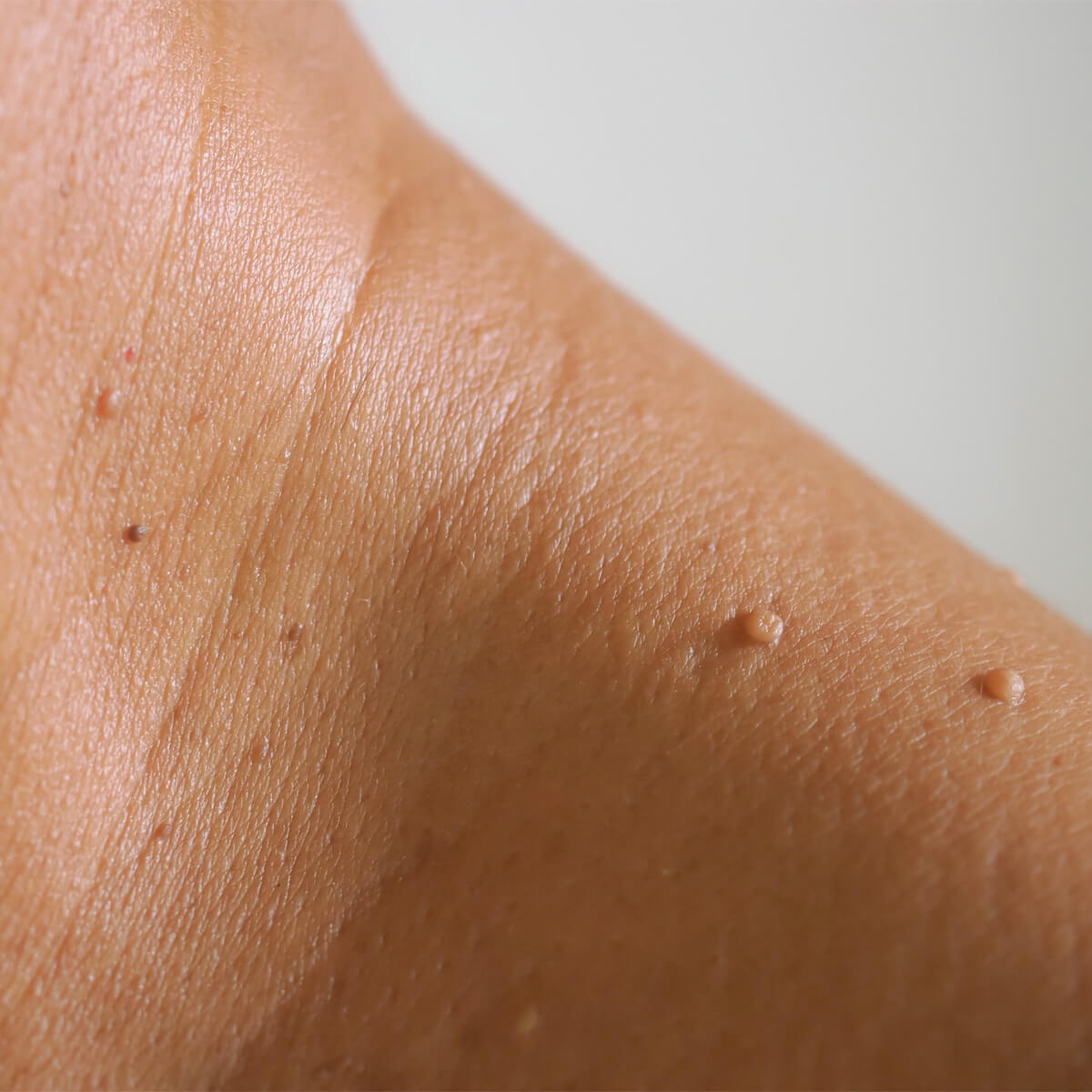 쥐젖이 생기는 이유