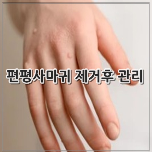 편평사마귀 제거후 관리