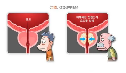 전립선비대증 치료