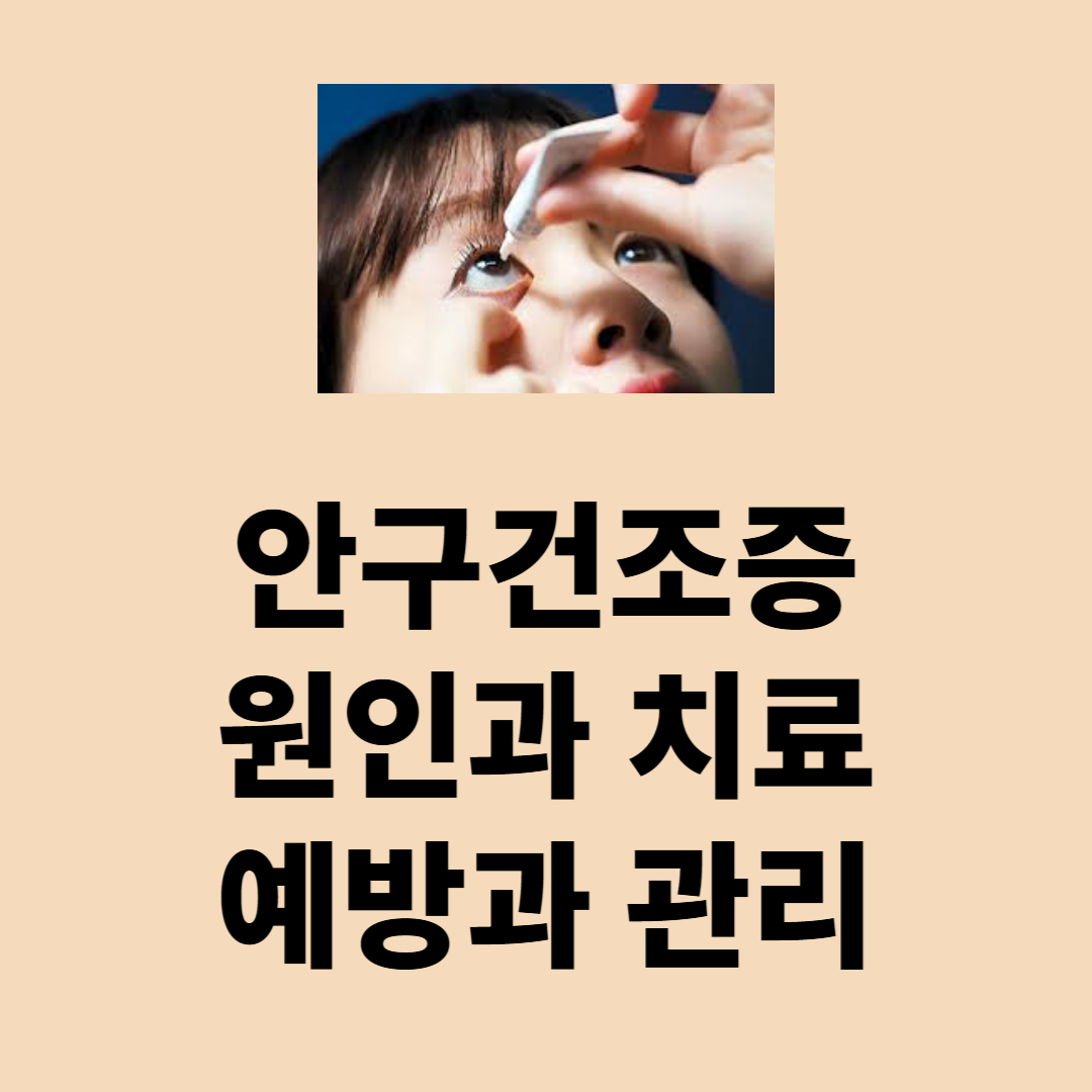 안구건조증 원인과 치료 방법, 예방과 관리법