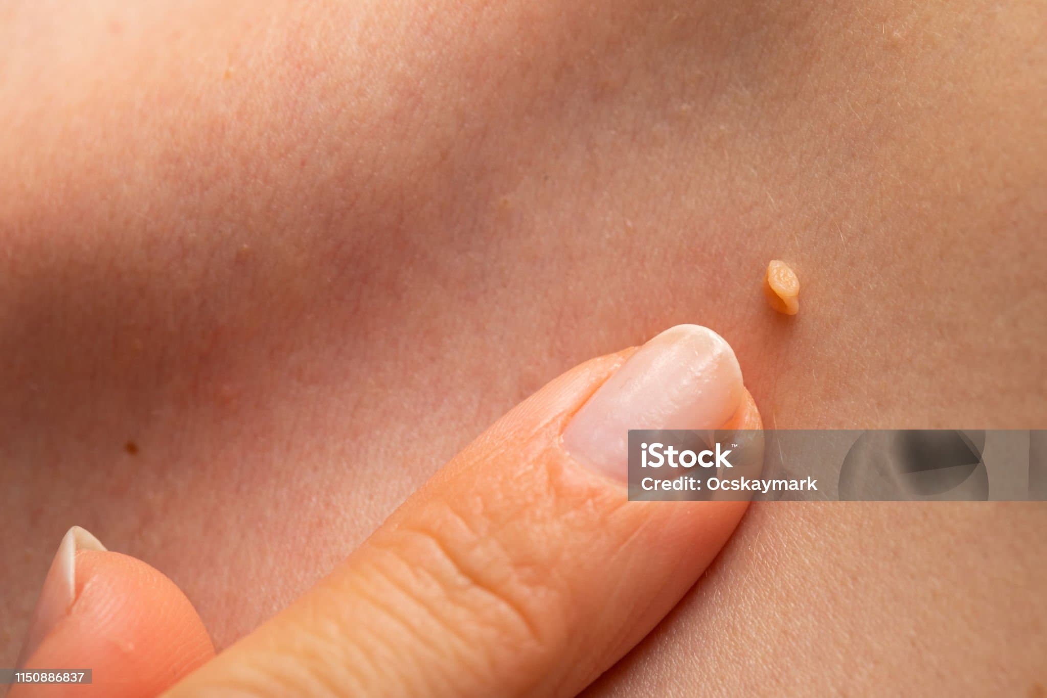 HPV 바이러스란? 증상부터 예방접종까지 완벽 정리