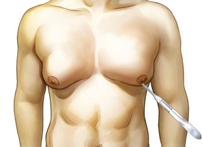 남성여유증 치료 과정 2