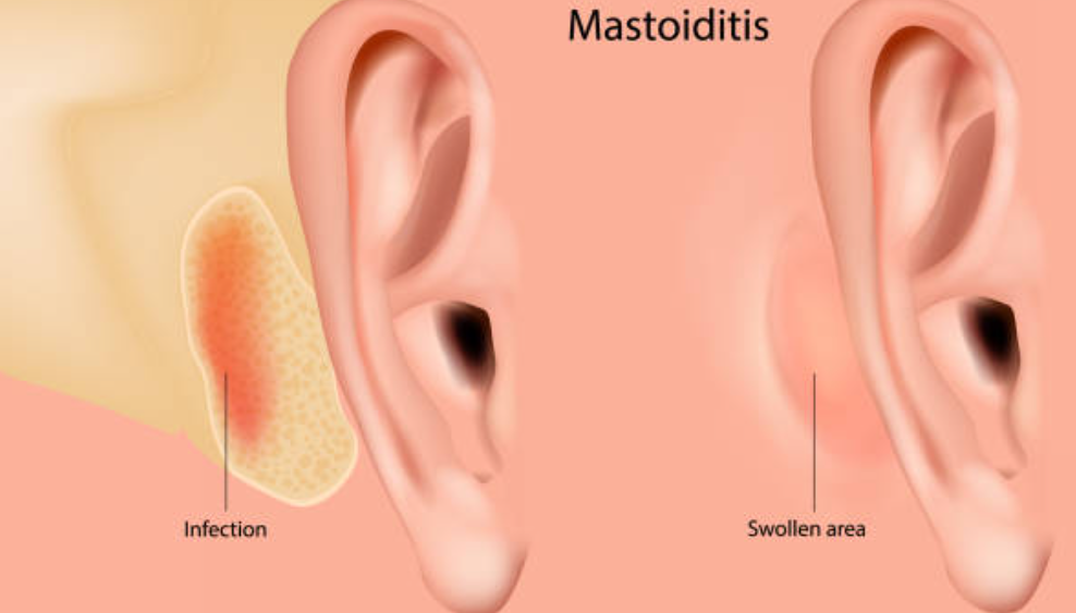 이석증과 관련된 사진1