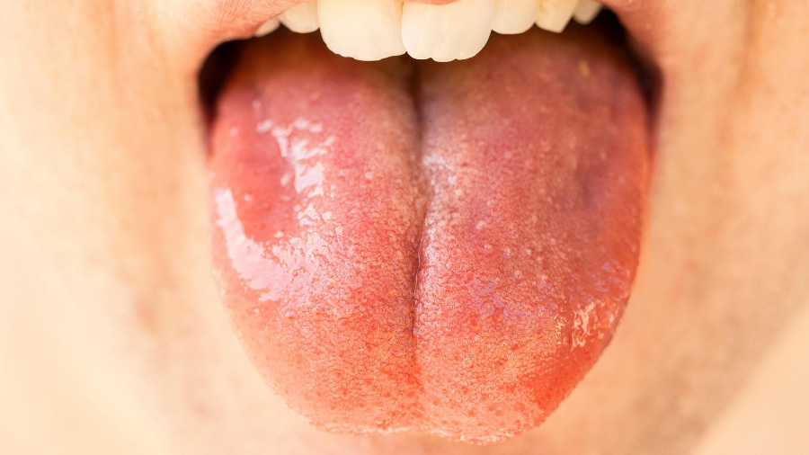 혀를 내밀어 하얀 백태와 돌기가 돋아 있는 설첨, 그리고 혀의 테두리에 이빨 자국이 있는 치흔을 보여주고 있는 혀의 사진