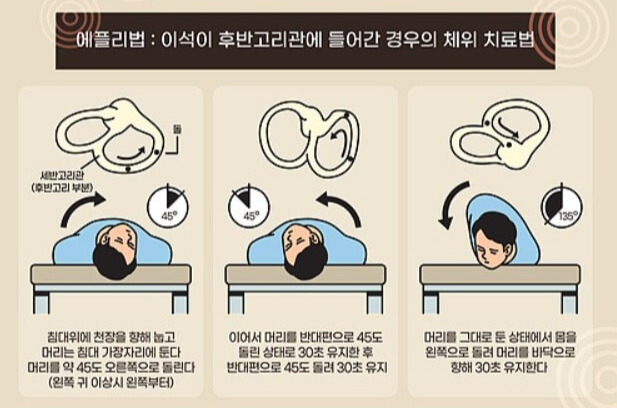 이석증 자가치료