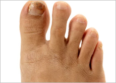 발톱무좀 증상을 보이는 사람들 발 이미지