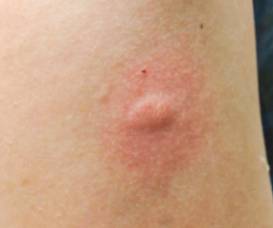 모기 물려서 가려울 때