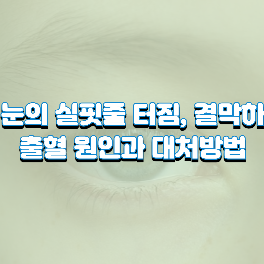 눈의 실핏줄 터짐, 결막하 출혈 원인과 대처방법