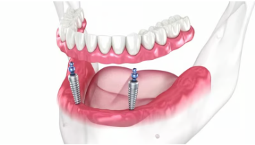전체 임플란트 시술과정