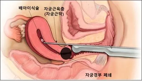 출산 후 자궁수축 기간_8