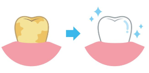 이빨이 노란 건 왜