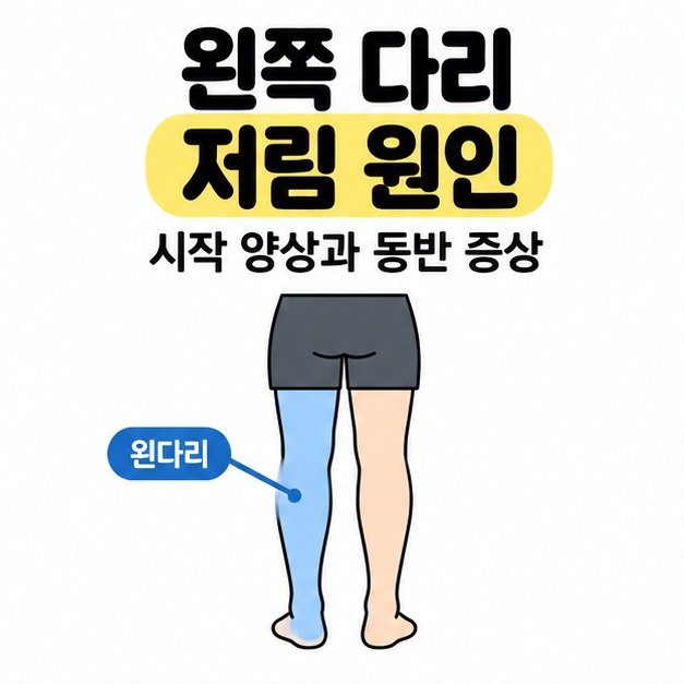 왼쪽 다리 저림 원인이라는 제목 아래 인물의 뒷모습에서 왼다리를 파란색으로 표시하고 시작 양상과 동반 증상 확인을 안내한 그림