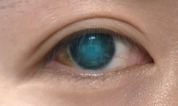 백내장-상태의-눈