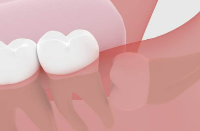 사랑니 발치후 식사 주의사항 가이드