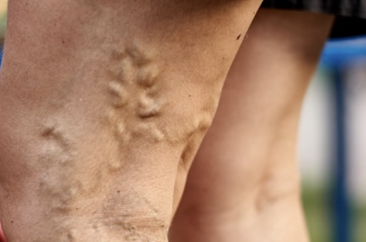 하지 정맥류 증상 28