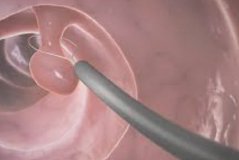 대장내시경 후 용종 제거 수술