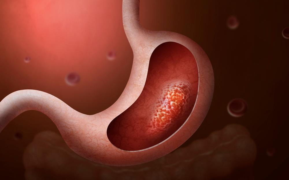 위암 3기 생존율