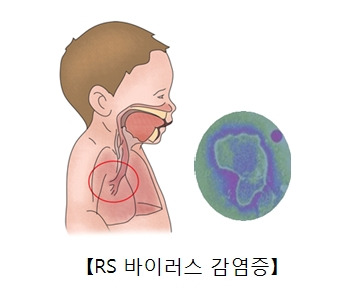 RSV 바이러스 증상&middot;원인&middot;치료방법