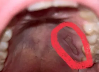 입천장 헐었을 때 면역력 저하 관련 증상과 영양 관리법_14