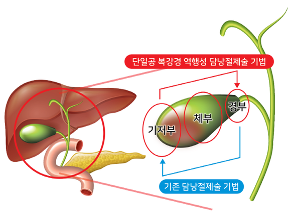 복강경 담낭절제술