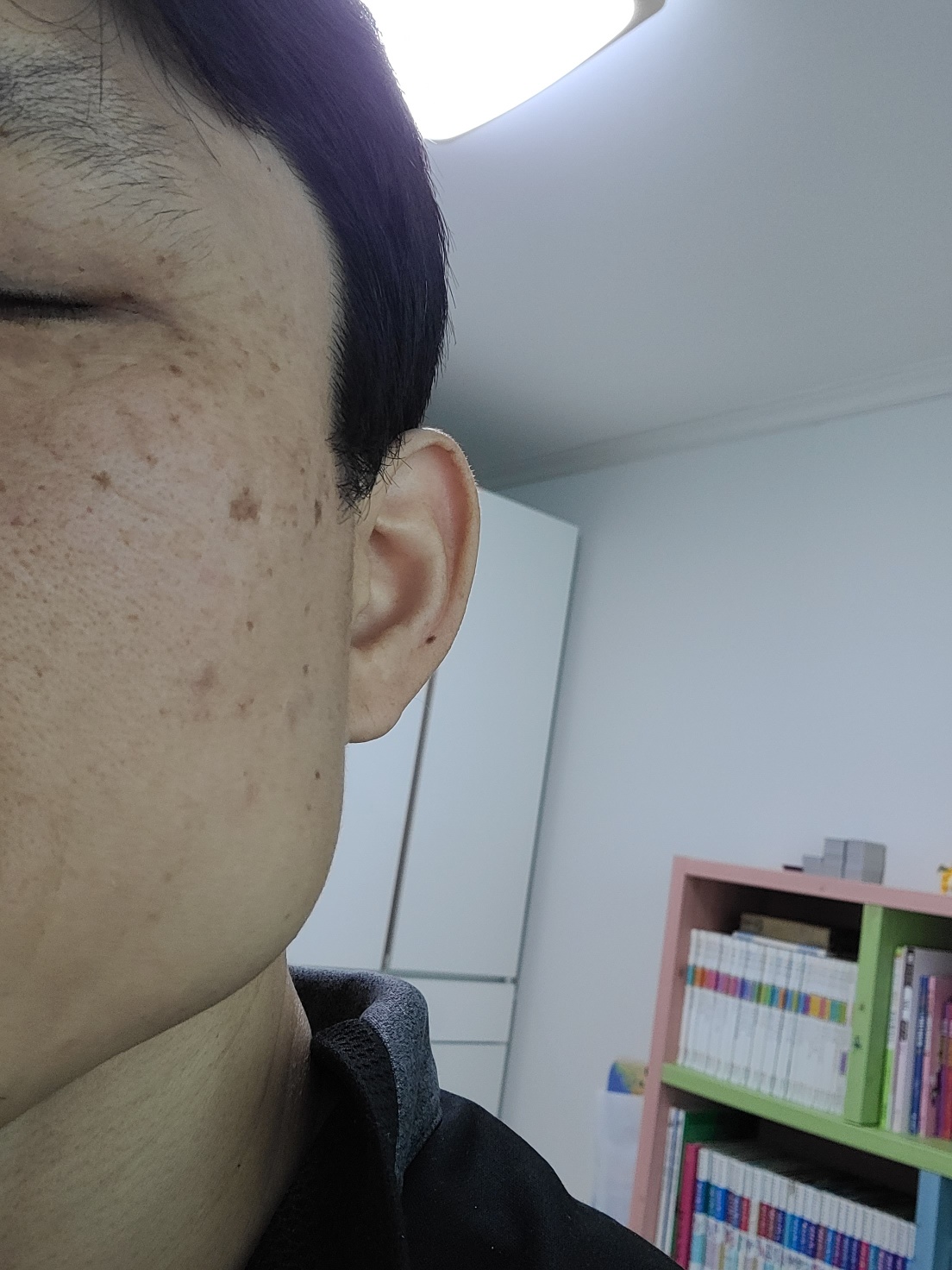 잡티·검버섯 관련 사진