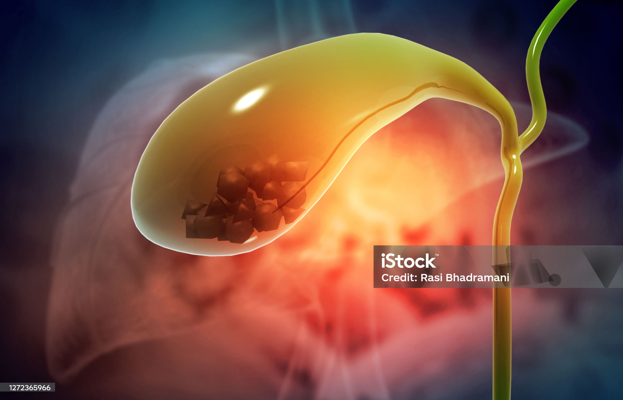 담석증-관련-사진