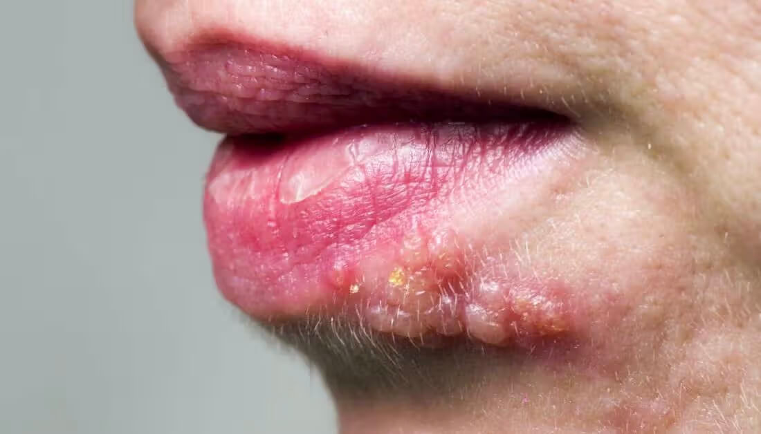 대상포진 초기증상