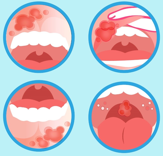 우리가 모르는 자가변역 질환 3탄 - 베치트병, 쇼그렌증후군
